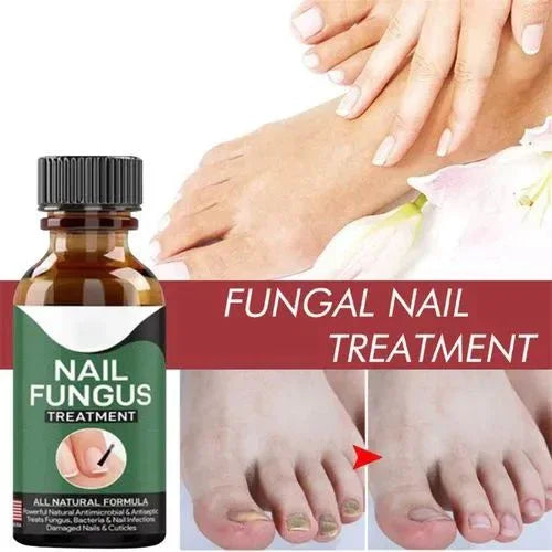 Fast Nail Fungal Treatment Repair Serum | Anti-Fungus | Nail Repair Essence Mayari Super Store