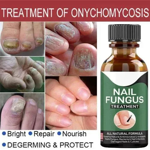 Fast Nail Fungal Treatment Repair Serum | Anti-Fungus | Nail Repair Essence Mayari Super Store