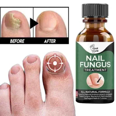 Fast Nail Fungal Treatment Repair Serum | Anti-Fungus | Nail Repair Essence Mayari Super Store